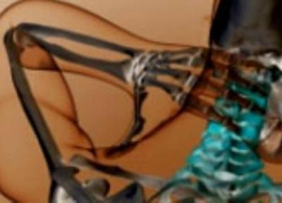 صدمات شلاقی ناحیه گردن صدمات شلاقی ناحیه گردن